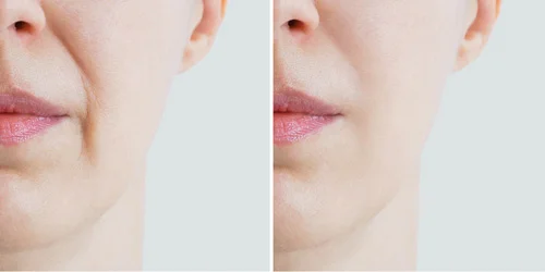 Cheek-filler-before-and-after