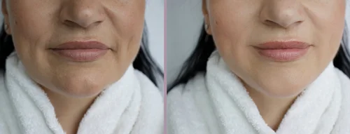 chin-fillers-before-and-after