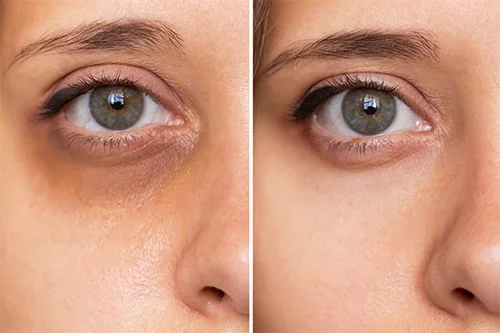 dark-circle-under-eye-filler-before-and-after