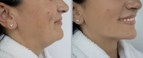 double-chin-filler-before-and-after