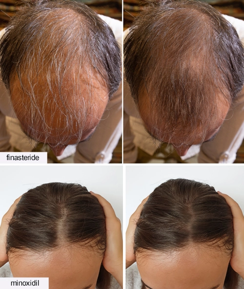 finasteride and minoxidil before and after