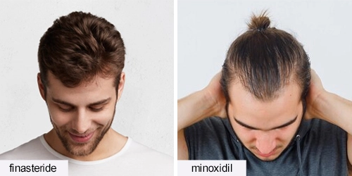 finasteride vs minoxidil results