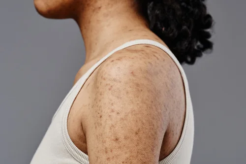 hyperpigmentation-on-arms