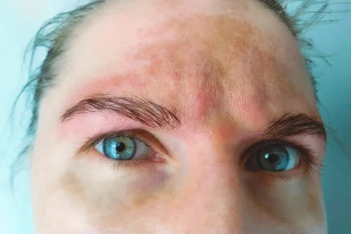 hyperpigmentation-on-forehead