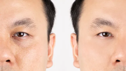 juvederm-under-eyes-before-and-after