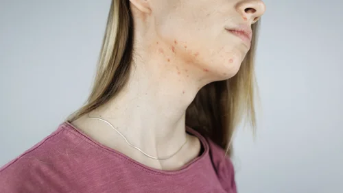 melasma-on-neck