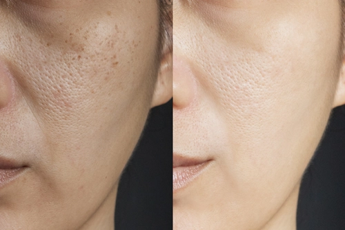 microneedling before and after pores v1