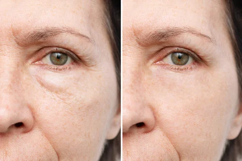 restylane-under-eyes-before-and-after