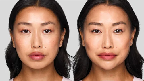 round-face-cheek-filler-before-and-after