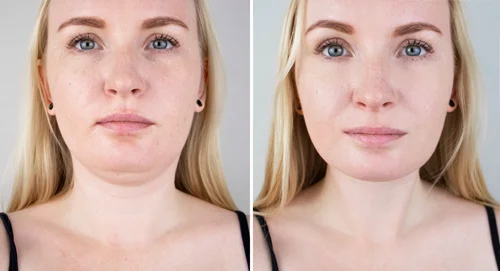 round-face-chin-filler-before-and-after