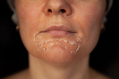 skin peeling after microneedling v1