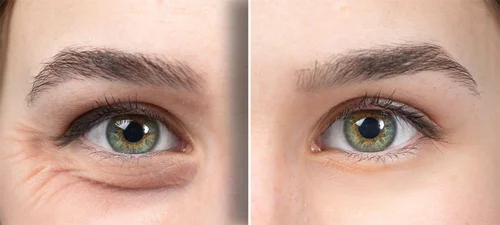 under-eye-filler-before-and-after