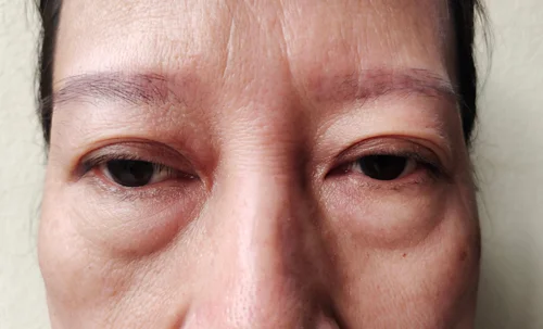 under-eye-filler-gone-wrong