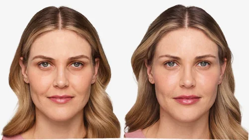 voluma-in-cheeks-before-and-after