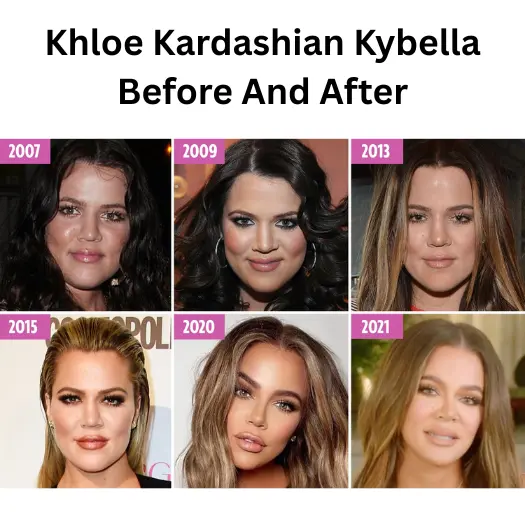 Khloe Kardashian Kybella Before And After (1)