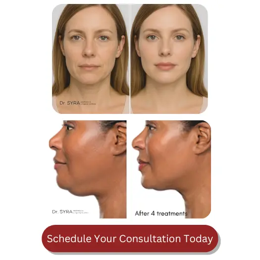 Kybella Befre And After (1)