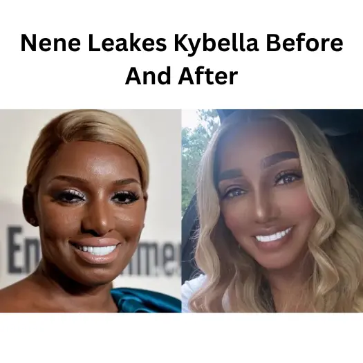 Nene Leakes Kybella Before And After (1)