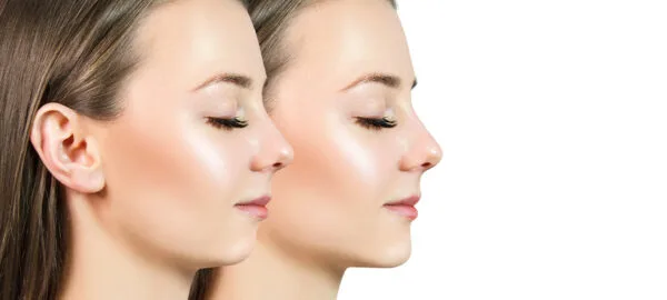 kybella cost