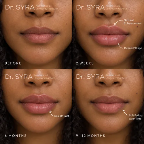 lip-filler-results-over-time-manhattan-nyc-syra-aesthetics