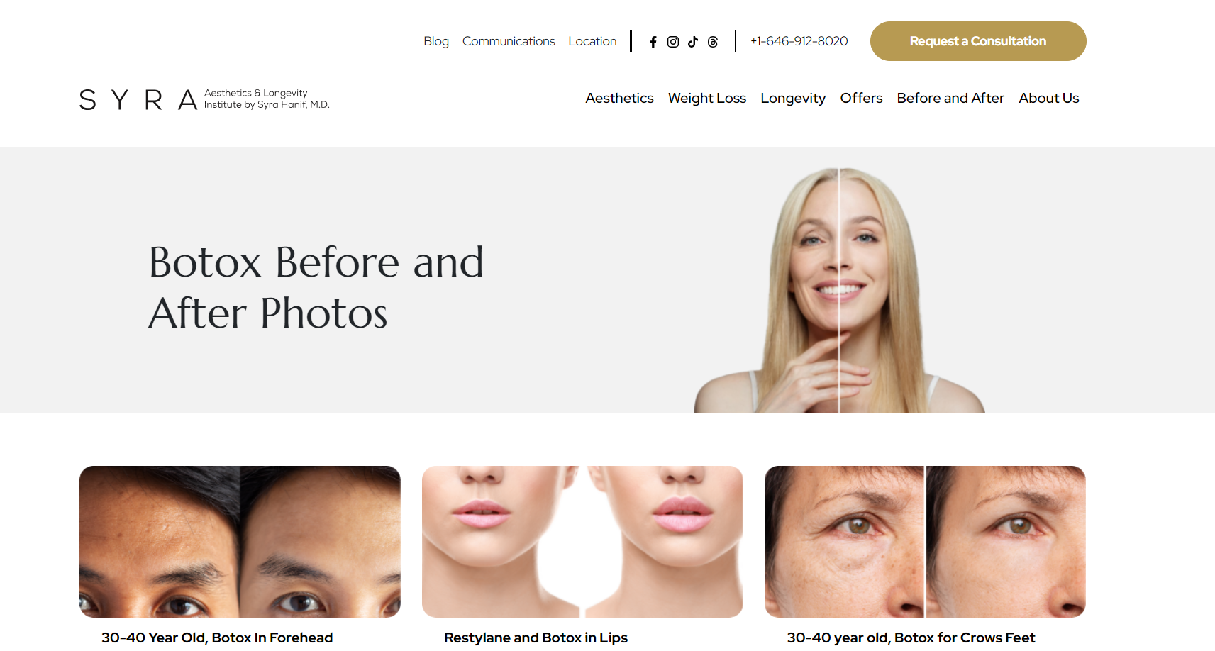 Botox Before & After Photos - Real Transformations, Smooth Skin