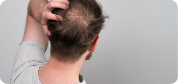 Androgens Alopecia