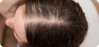 Thinning hair