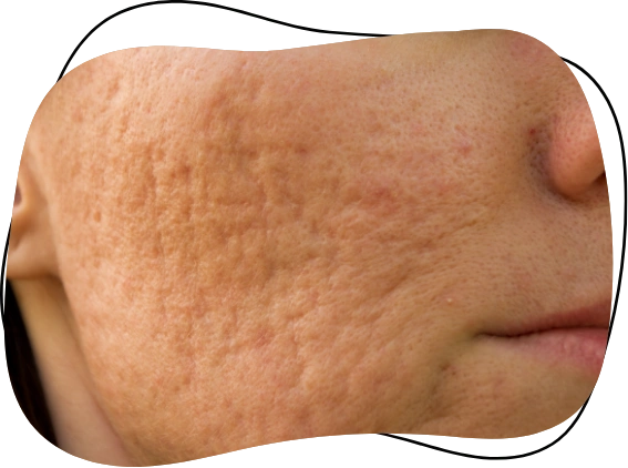 What are acne scars?