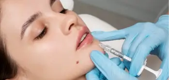 Lip Flip injection to enhance upper lip shape.