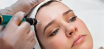 Microneedling with PEP treatment on her forehead