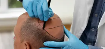 Microneedling with PRP for Hair treatment
