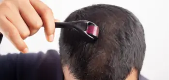 microneedling procedure on the scalp of a man, using a derma roller to stimulate hair growth and improve hair density.