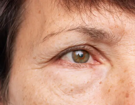 before Botox treatment