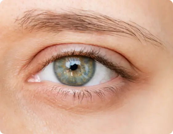after crows feet treatment
