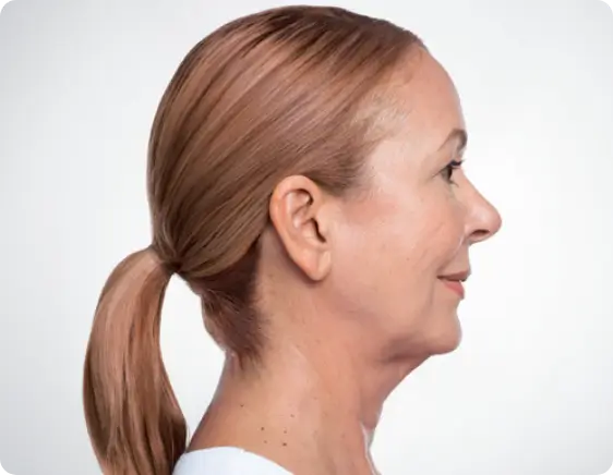 dermal filler after treamtent