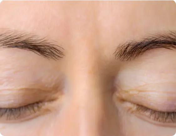 Dysport after treatment