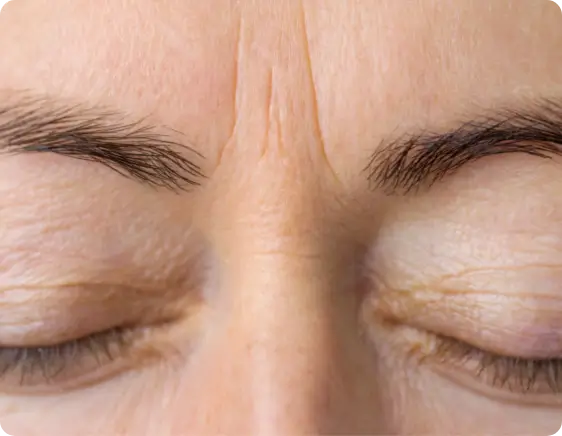 Dysport before treatment