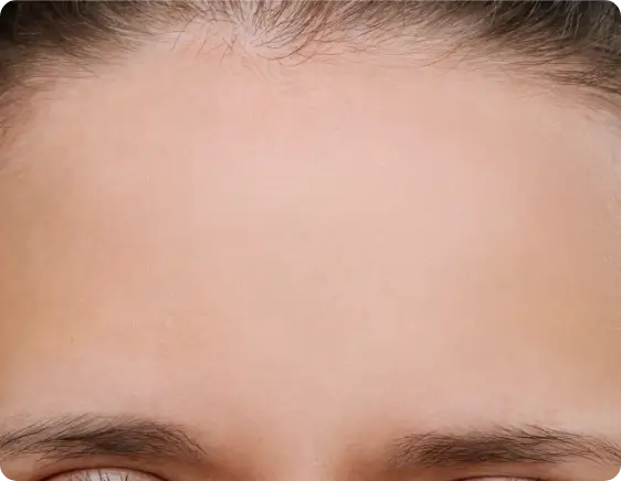 Dysport after treatment
