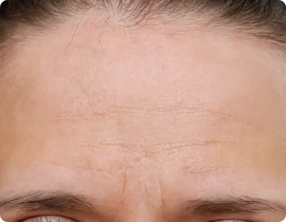 Dysport before treatment