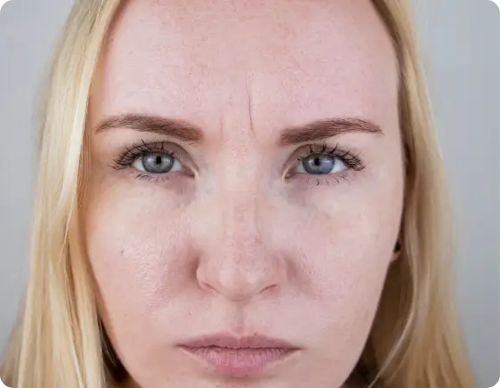 jeuveau before treatment