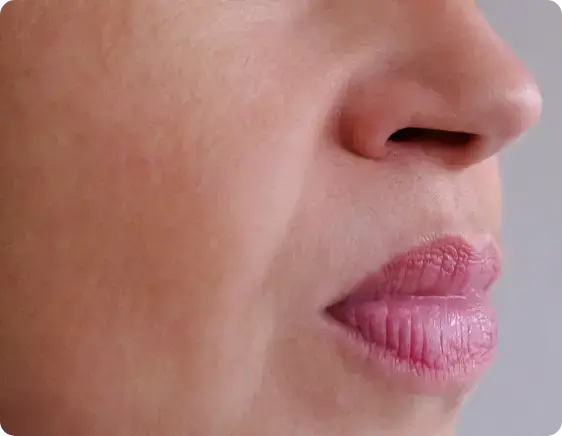 lip flip after treatment