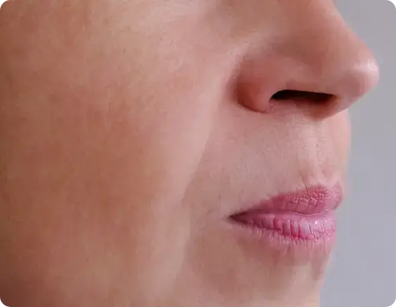 lip flip before treatment