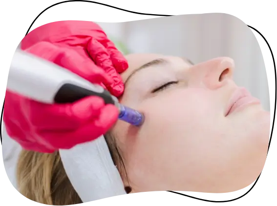 Microneedling for Your Face