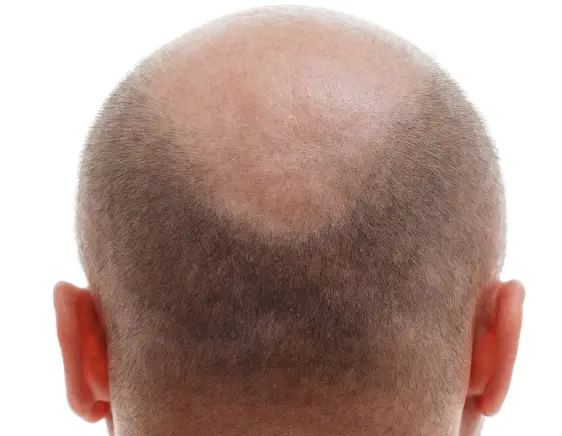 Enhanced Hair Growth from Microneedling Before