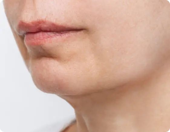 microneedling after result