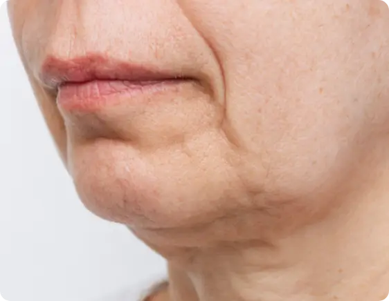 microneedling before result