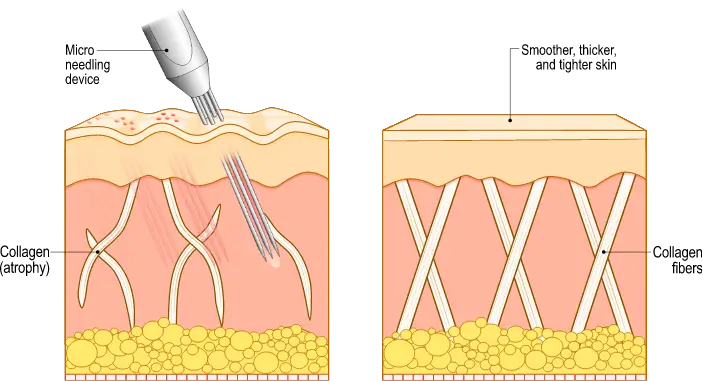 microneedling working process