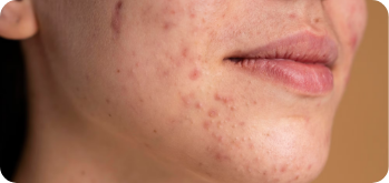 microneedling treatment for acne-prone skin with PEP Factor
