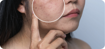 Revitalizing microneedling procedure for dull, tired-looking skin with PEP Factor