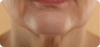 microneedling treatment for sagging skin enhanced by PEP Factor