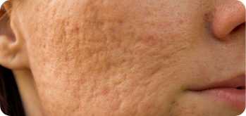 microneedling solution for scarred skin using PEP Factor